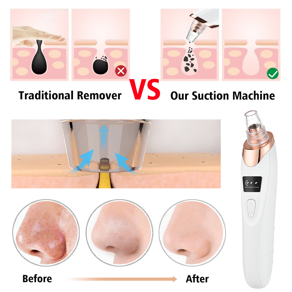 Comedondrukker Vacuüm Pore Cle - Nasal Aspirator recensie en prijs